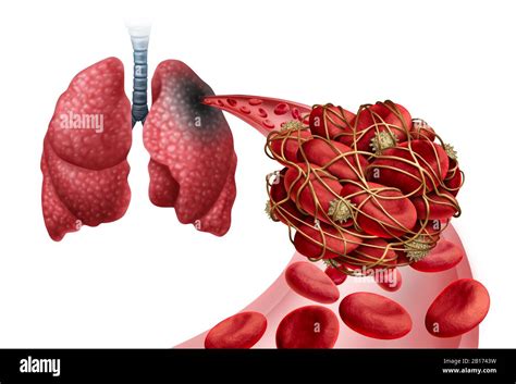 Pulmonary Embolism with a blood clot as a disease with a blockage of an artery in the lungs with ...