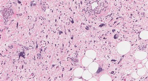 Dedifferentiated Liposarcoma Treatment Market Share To See