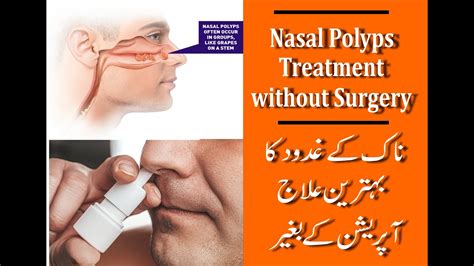 What Is Nasal Polyps - vrogue.co