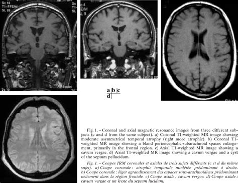 Schizophrenia Brain Ventricles