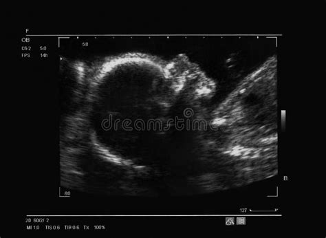 Ultrasound Of A Fetus At 26 Weeks Stock Photo - Image of healthcare, examination: 28135834