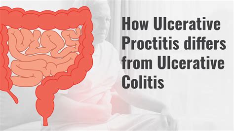 Ulcerative Proctitis Vs. Colitis: Causes, Symptoms, Treatment | HighCarbHealth