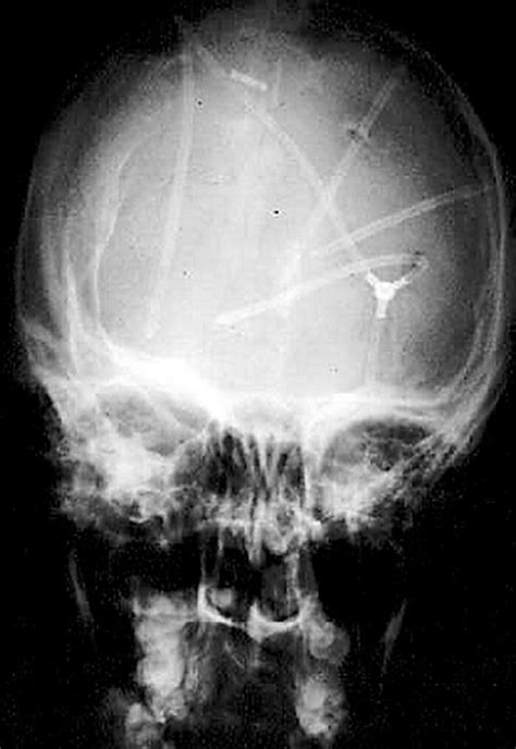 HYDROCEPHALUS AND SHUNTS | Buyxraysonline