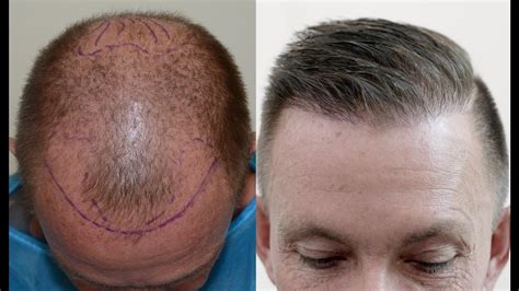 BUSTING MYTHS ABOUT HAIR TRANSPLANT - Tasteful Space