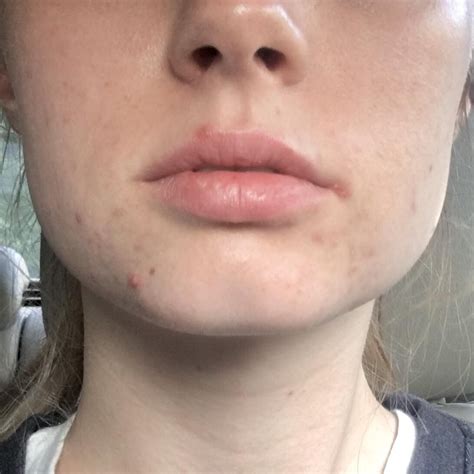 [SKIN CONCERN] (First time poster!) zits on lip line?! Post in comments | Pimples on lip line ...