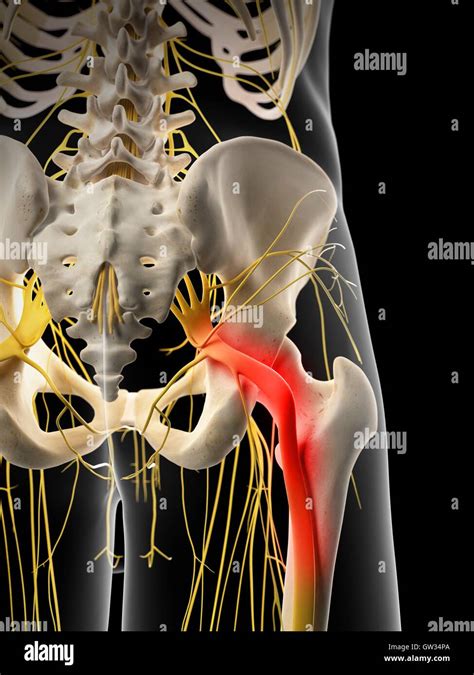 Human sciatic nerve pain, illustration Stock Photo - Alamy