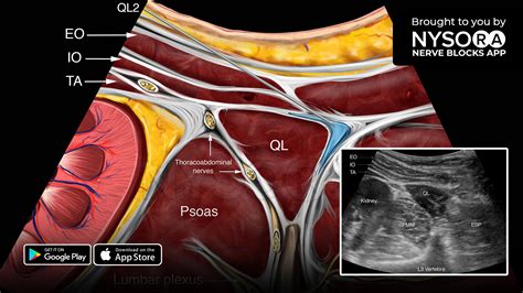 Quadratus Lumborum Block Ultrasound Nysora