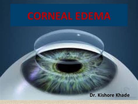 Corneal edema