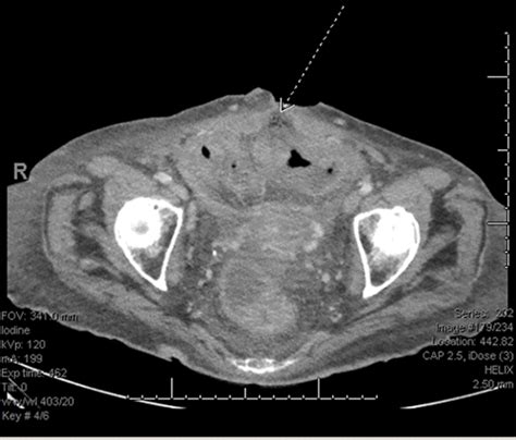 Acute Colocutaneous Fistula Management by Endoscopic Placement of Double Pigtail Stent | ACS