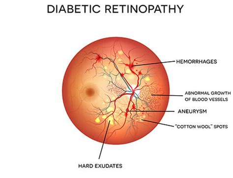 Diabetic Retinopathy | Star Retina