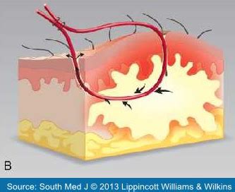 Incision and loop drainage of cutaneous abscesses: What’s the evidence? – PEMBlog