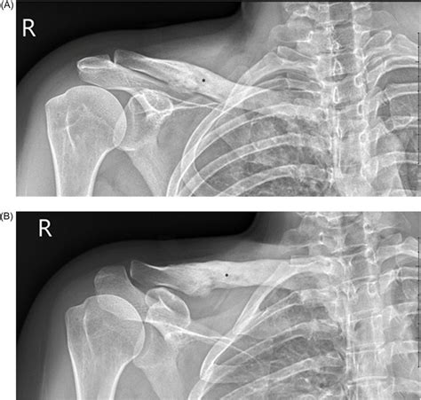 -Radiographs of the right clavicle, AP (A) and AP with cephalad... | Download Scientific Diagram