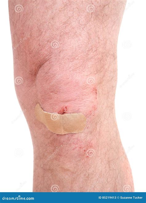 Scraped knee stock image. Image of bleed, knee, medical - 85219413