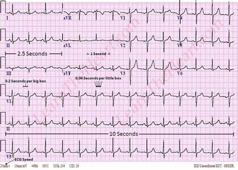 Residency by Kehakasha'n hasan | Ecg interpretation, Ecg rhythms, Interpretation