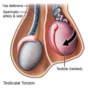 Does vasectomy increase the risk of torsion of the testicle - No ...