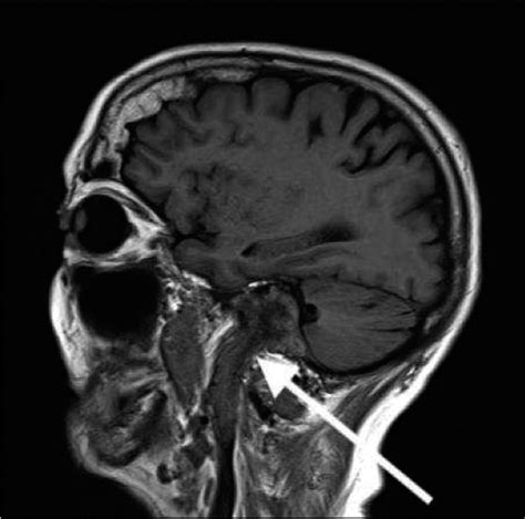 Glomus Tumor Ear