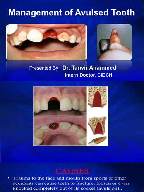 Management of Avulsed Tooth | PDF