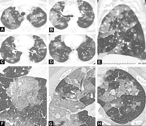 CT halo sign and crazy paving pattern due to lung metastases hemorrhage after sunitinib therapy ...