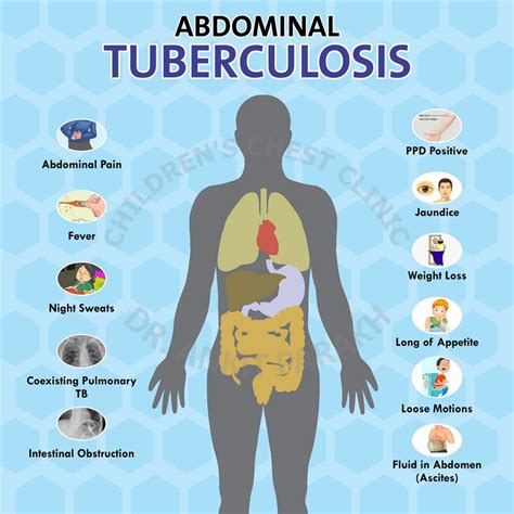 Abdominal Tuberculosis - Dr. Ankit Parakh