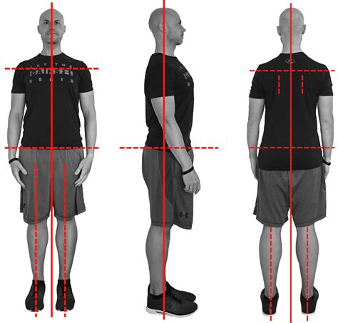 Postural assessment – Static posture