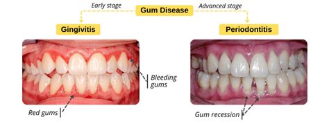 Gingivitis vs Periodontitis - Share Dental Care