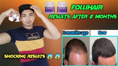 Follihair Results And Review After 2 Months | Hair Regrowth ? | hair fall control? - YouTube