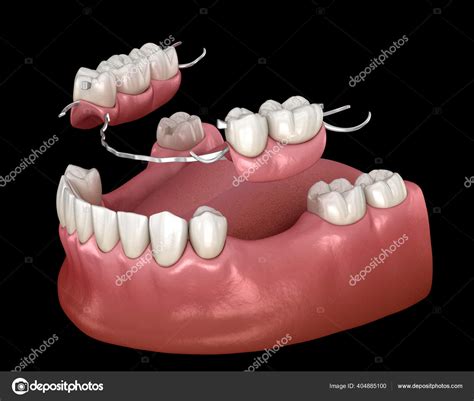 Mandibular Partial Denture