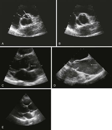 The Bicuspid Aortic Valve and Associated Aortic Disease | Thoracic Key