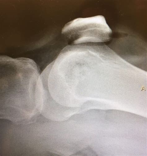 Case Study: Gunshot Wound to the Thigh - Clinical Advisor