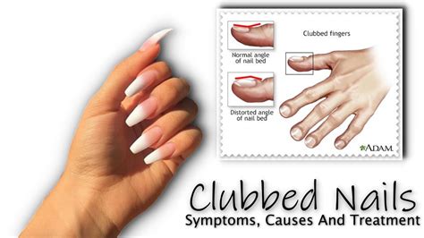 Clubbed Nails : Symptoms, Causes And Treatment - Fancy Nail Art