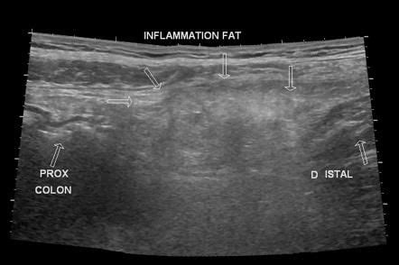 Epiploic appendagitis | Radiology Case | Radiopaedia.org | Radiology ...