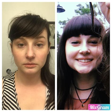 Embracing my new moon face. Day 1 of prednisone vs. Day 21. : r/CrohnsDisease