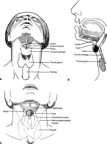 Thyroglossal Duct Cyst Embryology