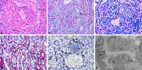 Pathological findings of the renal biopsy. The major finding of the... | Download Scientific Diagram