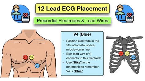 12 Lead ECG Placement: Diagram and Mnemonic for Limb and Precordial Electrode Location — EZmed