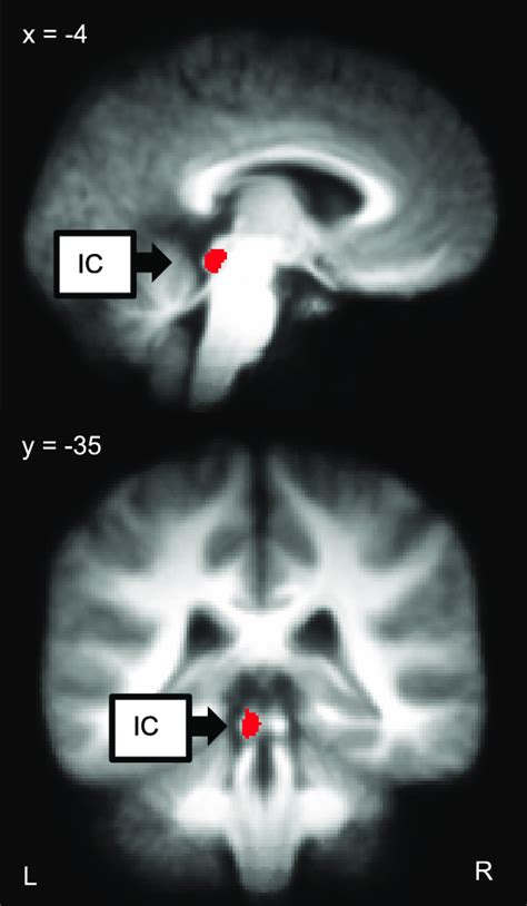 The left inferior colliculus (IC) was significantly activated by the ...