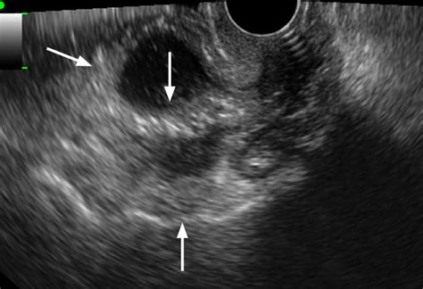 Tubo-ovarian abscess in a 35-year-old woman. Transvaginal... | Download Scientific Diagram