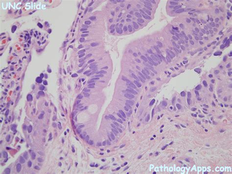 intestinal metaplasia urinary tract histology