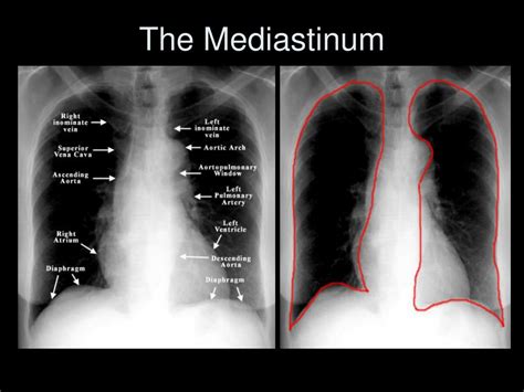 PPT - The Complete Idiot’s Guide to Reading the X Ray PowerPoint Presentation - ID:583063