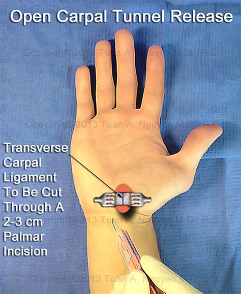 Open Carpal Tunnel Release - Carpal Tunnel Syndrome Portland Hand Surgery