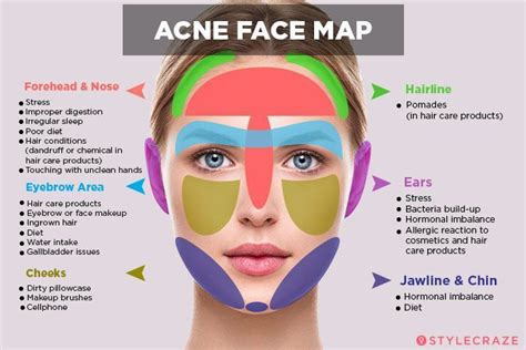 Acne Face Map: What Is Your Acne Trying To Tell You? | Face mapping acne, Face acne, Acne skin