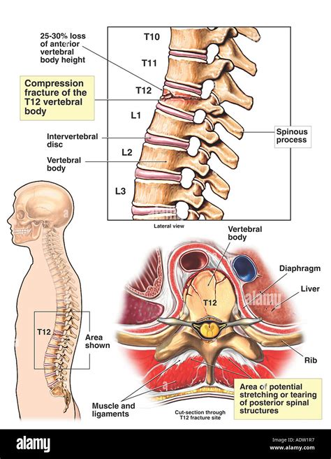 Fractura por compresión del cuerpo vertebral de T12 Fotografía de stock ...