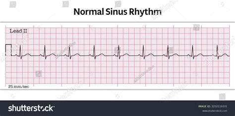 Ecg Tracing Reveals Normal Sinus Rhythm At 81 Bpm