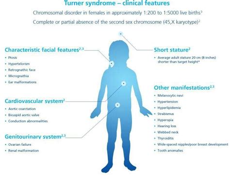 Turner's Syndrome | Medicine