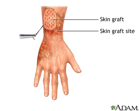 Skin graft - series—Procedure: MedlinePlus Medical Encyclopedia