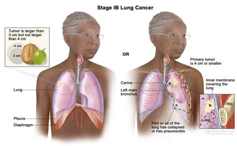 Non-Small Cell Lung Cancer | Vanderbilt-Ingram Cancer Center