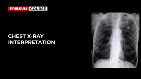 Chest X-Ray Interpretation | DrBeen