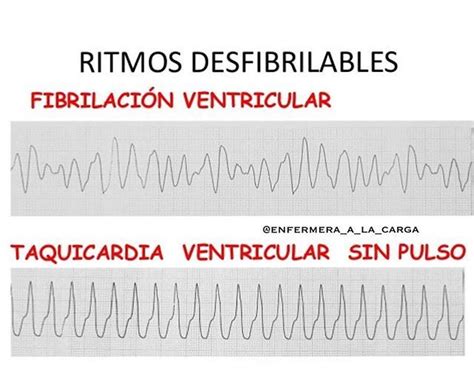 three different types of sin pulses with the words fibricion ventricular