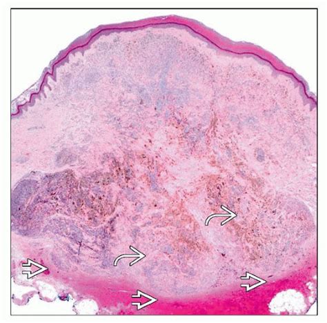 Cellular Blue Nevi | Basicmedical Key