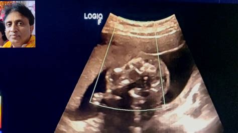 Anomaly Scan 20 weeks Pregnancy tricks and tips Level 2 scan - YouTube